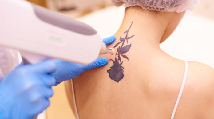 Technologies for tattoo removal